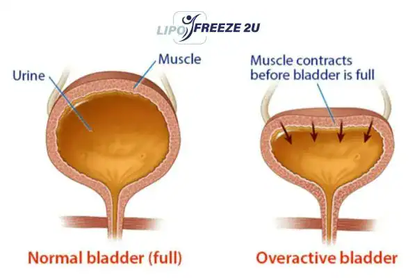 diagram of overactive bladder treatment Warwickshire