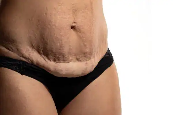 loose skin after weight loss injections Warwickshire