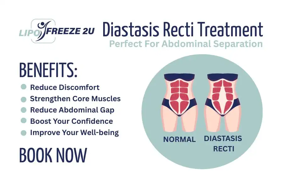 Benefits of body toning treatment Warwickshire for Diastasis recti