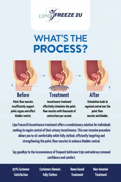 Diagram of how incontinence treatment Warwickshire works.