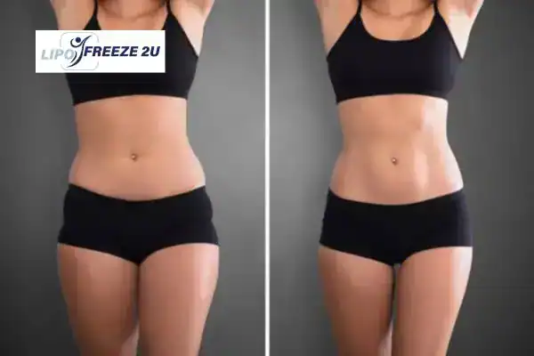 How Can LIPO FREEZE 2U Support Your Post-Pregnancy Body Recovery Warwickshire?