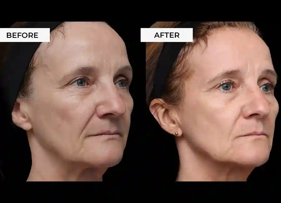 How Many RF Microneedling Sessions Will You Need to See a Difference Warwickshire?