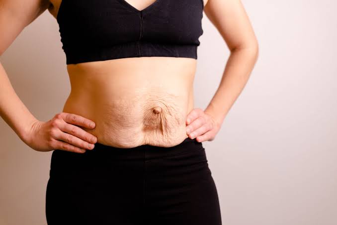Is Surgery Really the Only Way to Repair Diastasis Recti Warwickshire?