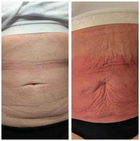 How Does RF Microneedling Improve Crepey, Thin and Uneven Skin Texture Warwickshire?