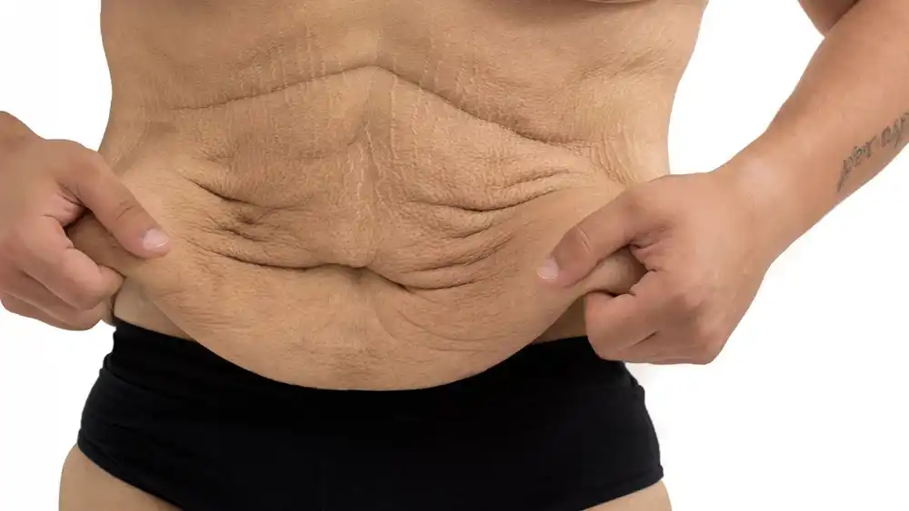 Why Does Weight Loss Medication Leave Some People With Loose or Sagging Skin Warwickshire?